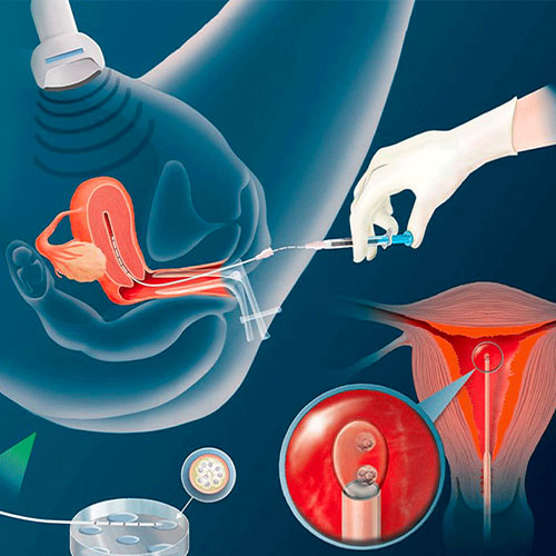 Intrauterine,insemination IUI, IVF, Donor IVF
